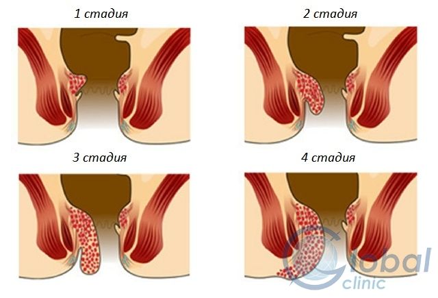 Симптомы и стадии геморроя