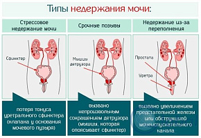 Причины и лечение недержания мочи